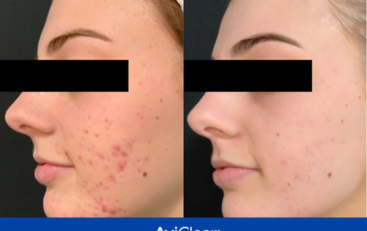 Aviclear Before & After 3 treatments