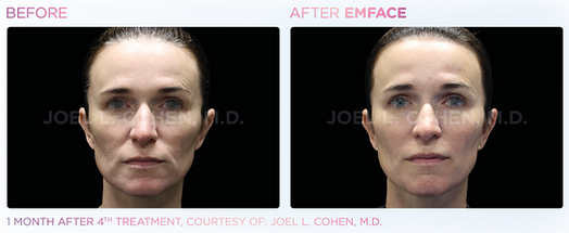 Emface_PIC_Ba-card-female-face-056_ENUS100_watermark.png