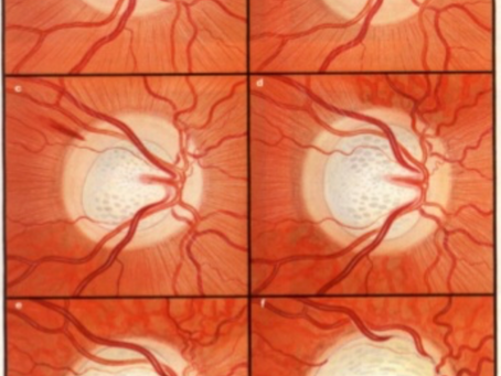 Glaucoma Awareness Month