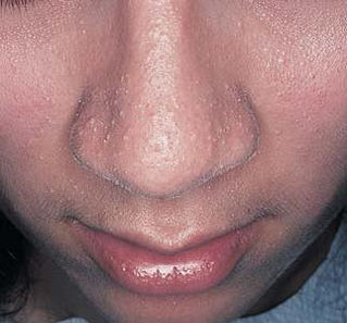 Seu nariz descasca sempre? veja como resolver em casa