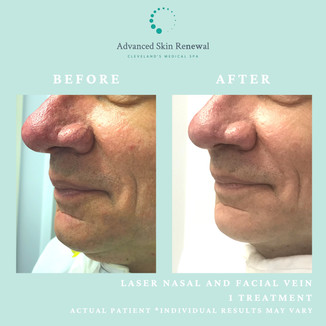 Laser Veins and Rosacea