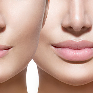 Lip Injections before and after