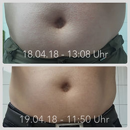Vorher-Nachher-LipoSulp, Dr.Juchheim, Juchheim, Dr. Juchheim, Effekt, Effect, Effect-Cosmetics, Cosmetics, Kosmetik, Effekt-Kosmetik, Effect-Food, Effekt-Food, ShapeWear, BBC, LipoSculp, 3D Bodylift, ByeByeCellulite, Bye Bye Cellulite, Cellulite, abnehmen, Detox, Keto, Programm, 28 Tage, Gewicht, Fett, Nahrungsergänzungsmittel, Nahrung, Schönheit, Falten, Füße, Massage, Öl, Augen, Serum, Serum4Eyes, Augen, Stirn, Stirnfalten, Zornesfalten, Schwangerschaftsstreifen, Dehnungsstreifen, Diät, Diäten, Hanf, Cannabis, CannaPur, CBD, CBA,CBGA, CBG, Vollextrakt, Natur, Samen, Lactoferin, Vitamine, Vitamin E, B, C, D, Sangokoralle, Organic, Organic Pearl of Sea, Day, Night, Lifting, Liften, Botox, Haut, Couperose, Silver, Gold, Silver Firming Serum, Haare, wachsen, MLM, Network, Network Marketing, glatte Haut, jünger aussehen, Douglas, Parfüm, Dekorative Kosmetik, Lippenstift, Lippen, Lippen Booster, Wimpern, Maskara, Aloe Vera, Body, Bodyforming, Sport, Fitness, Hamburg, Schönheitsfarm, Beauty
