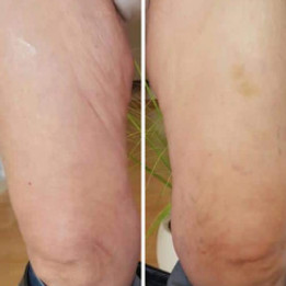 Vorher-Nachher 3D BodyLift, Dr.Juchheim, Juchheim, Dr. Juchheim, Effekt, Effect, Effect-Cosmetics, Cosmetics, Kosmetik, Effekt-Kosmetik, Effect-Food, Effekt-Food, ShapeWear, BBC, LipoSculp, 3D Bodylift, ByeByeCellulite, Bye Bye Cellulite, Cellulite, abnehmen, Detox, Keto, Programm, 28 Tage, Gewicht, Fett, Nahrungsergänzungsmittel, Nahrung, Schönheit, Falten, Füße, Massage, Öl, Augen, Serum, Serum4Eyes, Augen, Stirn, Stirnfalten, Zornesfalten, Schwangerschaftsstreifen, Dehnungsstreifen, Diät, Diäten, Hanf, Cannabis, CannaPur, CBD, CBA,CBGA, CBG, Vollextrakt, Natur, Samen, Lactoferin, Vitamine, Vitamin E, B, C, D, Sangokoralle, Organic, Organic Pearl of Sea, Day, Night, Lifting, Liften, Botox, Haut, Couperose, Silver, Gold, Silver Firming Serum, Haare, wachsen, MLM, Network, Network Marketing, glatte Haut, jünger aussehen, Douglas, Parfüm, Dekorative Kosmetik, Lippenstift, Lippen, Lippen Booster, Wimpern, Maskara, Aloe Vera, Body, Bodyforming, Sport, Fitness, Hamburg, Schönheitsfarm
