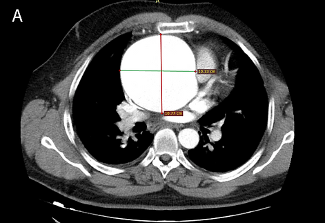 Preoperative 1A.png