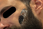 Frey's syndrome