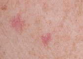 Basal Cell Carcinoma .jpg