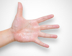 palms feet hands hyperhidrosis sweating