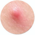 red bumps, papules