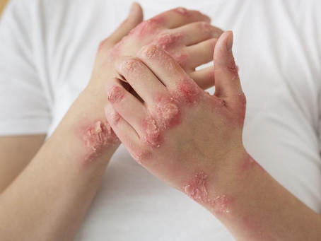 Día Mundial de la Psoriasis y la Artritis Psoriásica. Rompiendo mitos