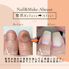 育爪Before→After深爪矯正2_edited.jpg