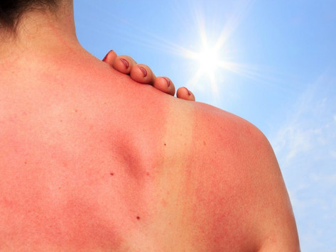 10 Studies on Sunburn Resistance