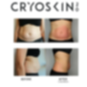 Cryoskin, Calabasas, Woodland Hills, West Hills, Malibu, Agoura Hills, Hidden Hills, Westlake Village, Thousand Oaks