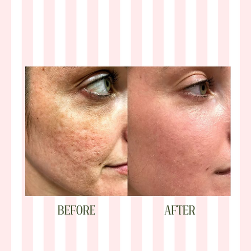 Before and after photo for the Halo laser