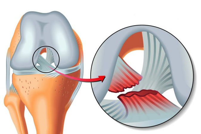 Rupture-des-ligaments-croises-symptomes-