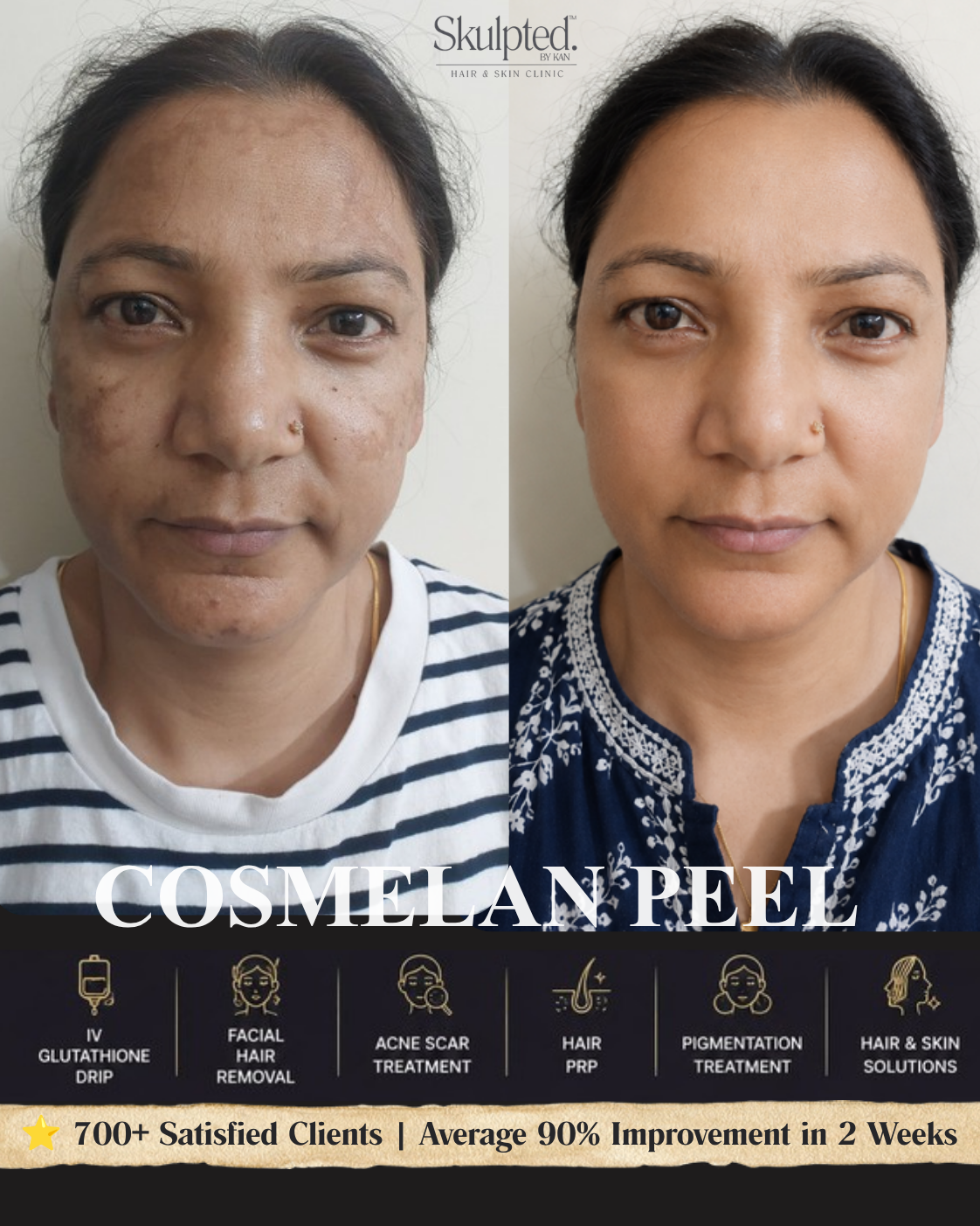 Real Skulpted client — clearer, more even skin, before & after