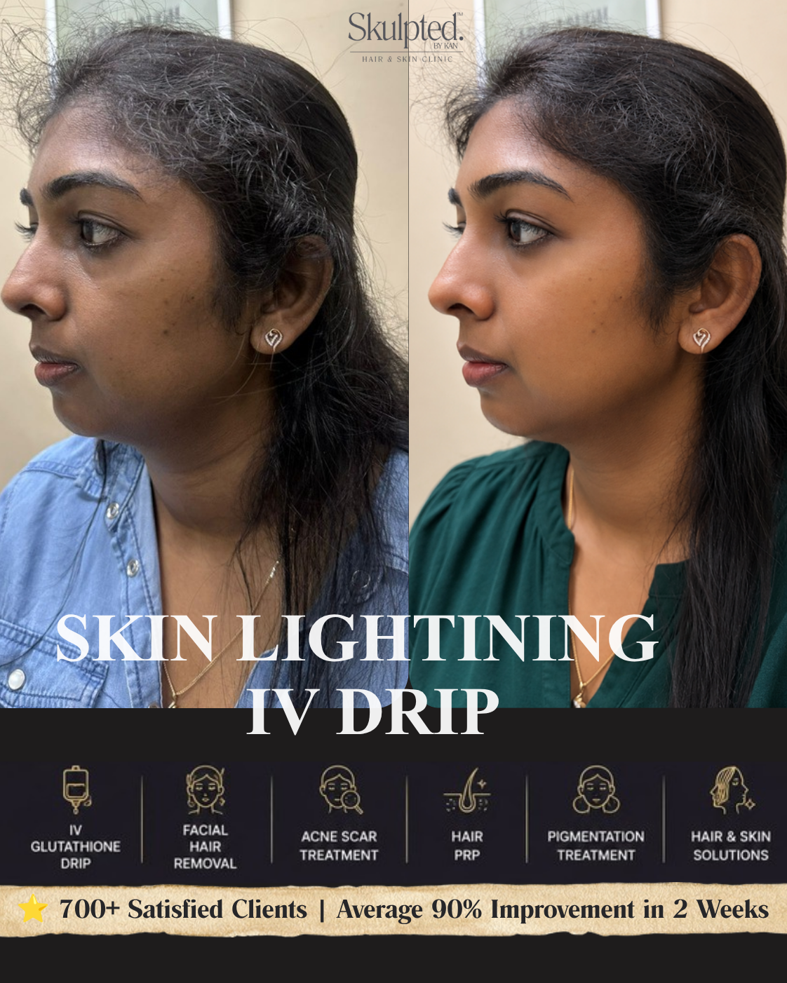 Real Skulpted client — skin lightening glutathione IV drip, before & after