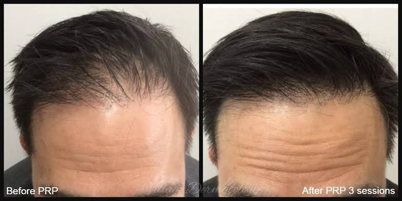 PRP therapy for hair growth