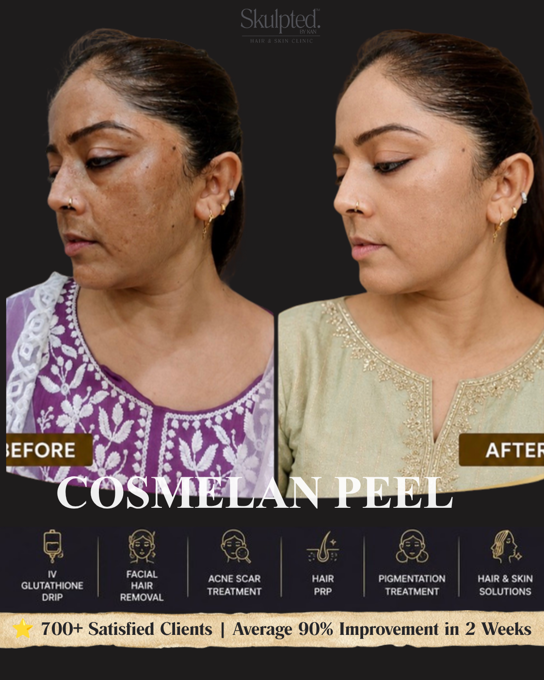 Real Skulpted client — clearer, more even skin, before & after