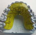 Dental Brace