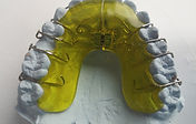 Dental Brace