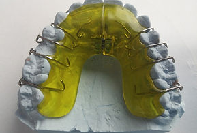 Dental Retainer Model