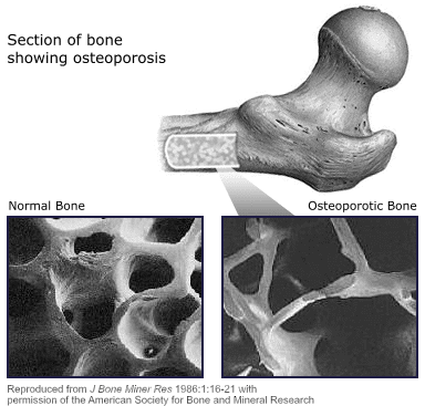 Osteoporosis