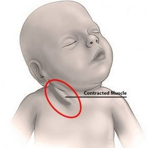 TORCICOLO EM BEBÊS, ENTENDA OS SINAIS E O QUE É DE UMA FORMA SIMPLES