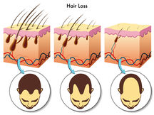 Hair Loss