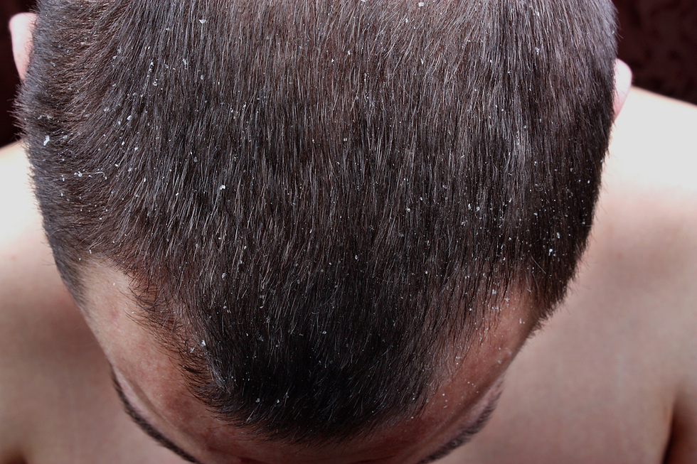 Dandruff