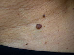 Does Warts Removal Work on Finger Warts