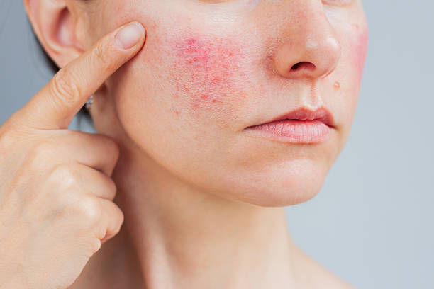 Can Acne Treatment Help Restore Confidence Lost Due to Acne Scars