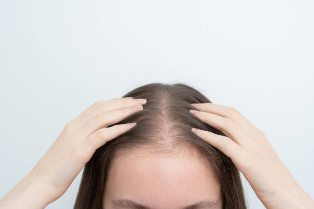 Does Exosomes Hair Treatment Prevent Hair Loss