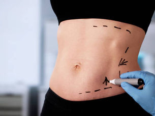 Does a Mini Tummy Tuck Remove Excess Belly Fat