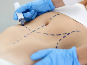 How Safe Is Tummy Tuck for Different Body and Age Types