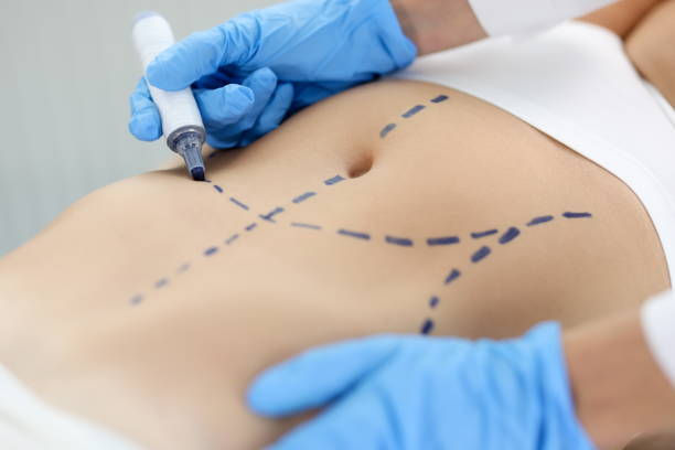 How Safe Is Tummy Tuck for Different Body and Age Types