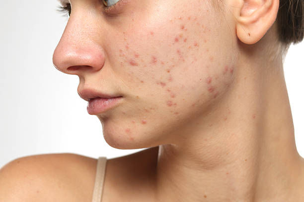 What Makes Acne Treatment Plans More Successful Overall Long Term