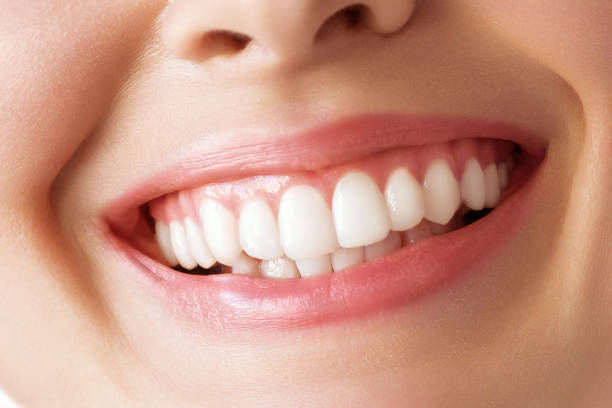 Does Teeth Whitening Work for Stains from Smoking
