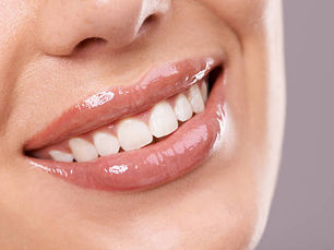 What Is the Lifespan of E-Max Veneers