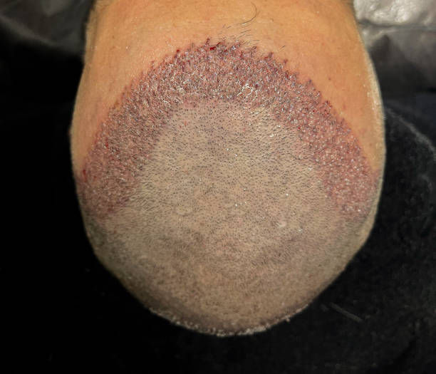 Can SMP Treatment Restore a Youthful Hair Appearance