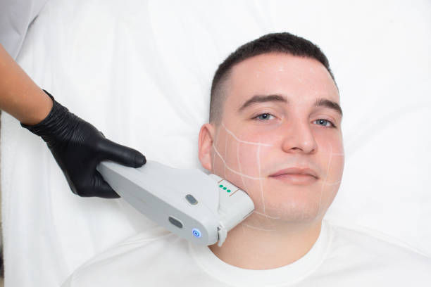 How Effective Is Beard Laser Hair Removal for Dark Hair