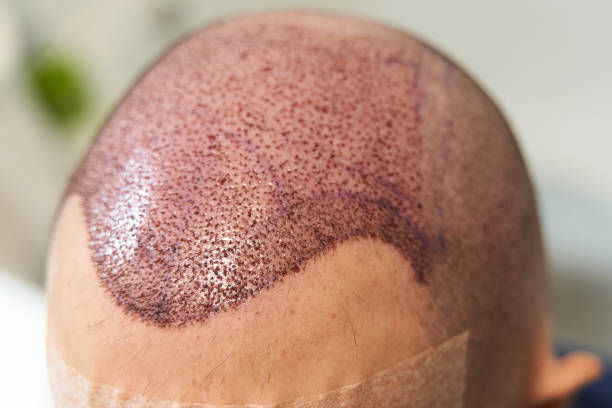 Can FUE Hair Transplant Boost Hair Confidence