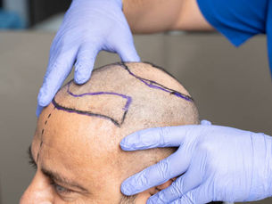 Is FUE Hair Transplant Ideal For A Small Donor Area