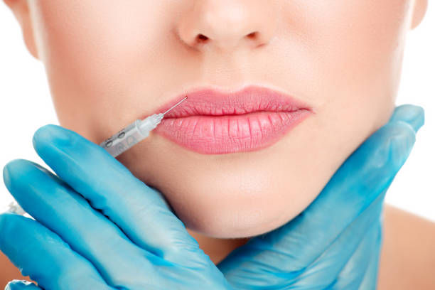 How Russian Lip Fillers Give Lips a Soft Natural Finish
