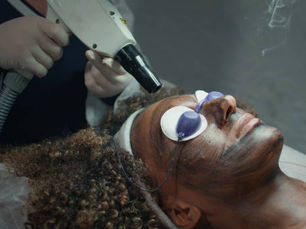 Does Laser Carbon Peel Reduce Fine Lines and Wrinkles