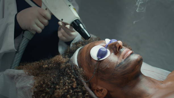 Does Laser Carbon Peel Reduce Fine Lines and Wrinkles