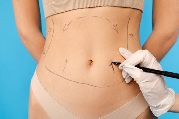 What Liposuction Procedures Improve Waistline Shape