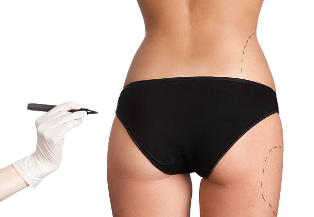 Does Body Jet Liposuction Work on Love Handles Well