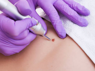 Can Mole Removal Be Done Without Surgical Procedures