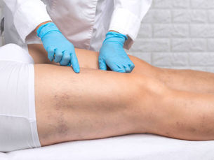 How Does Spider Vein Treatment Reduce Visible Veins